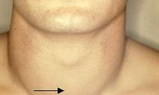 Bệnh bướu giáp lan tỏa nhiễm độc